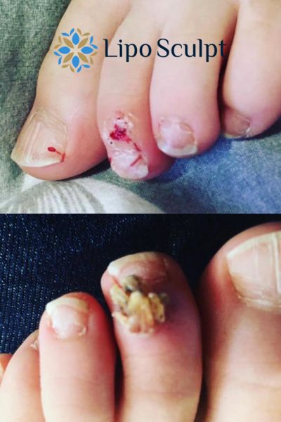 Wart removal customer results from Lipo Sculpt Bovingdon